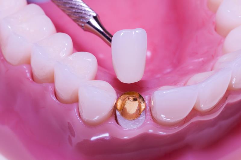 Dental Crowns