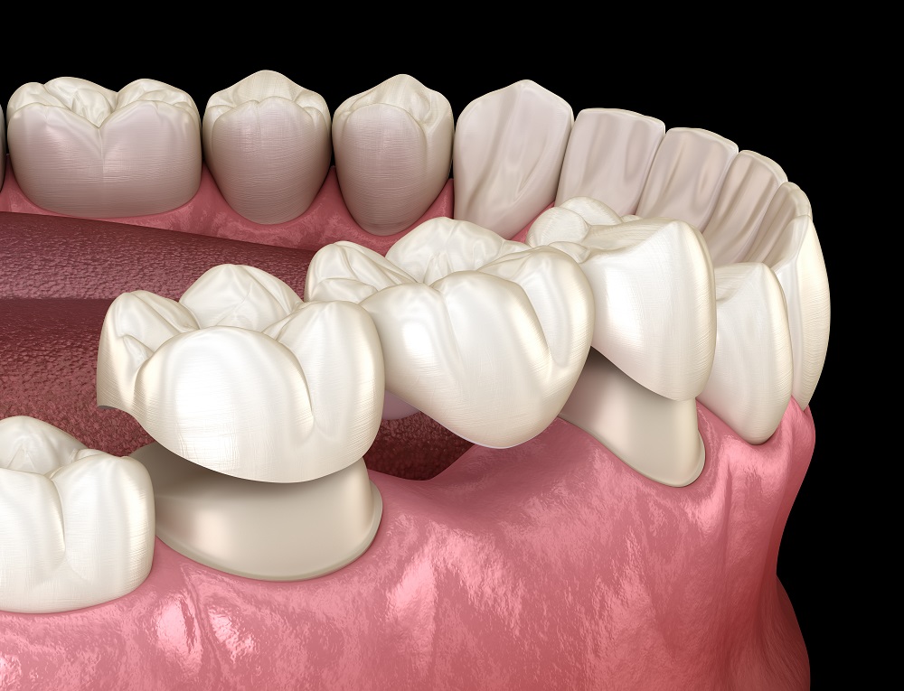 Porcelain Fixed Bridges